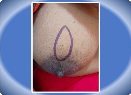 FIBROADENOMA BREAST